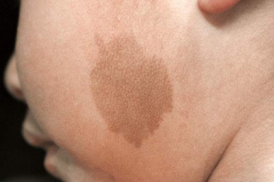 咖啡斑如何才能淡化?